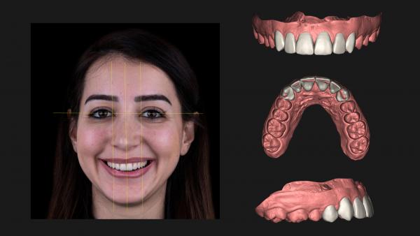 3D smile design