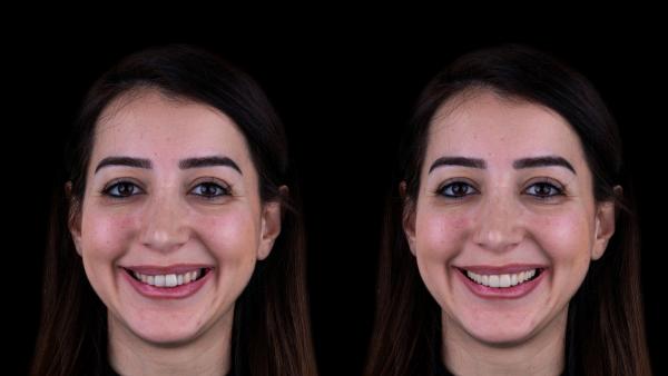Instant Smile Simulations