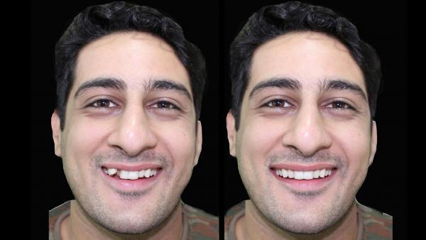 Orthodontic Simulations