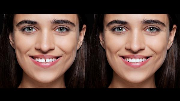 Diastema Closure