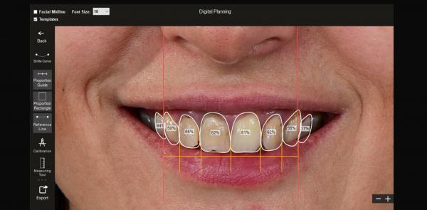 Digital Smile Designing